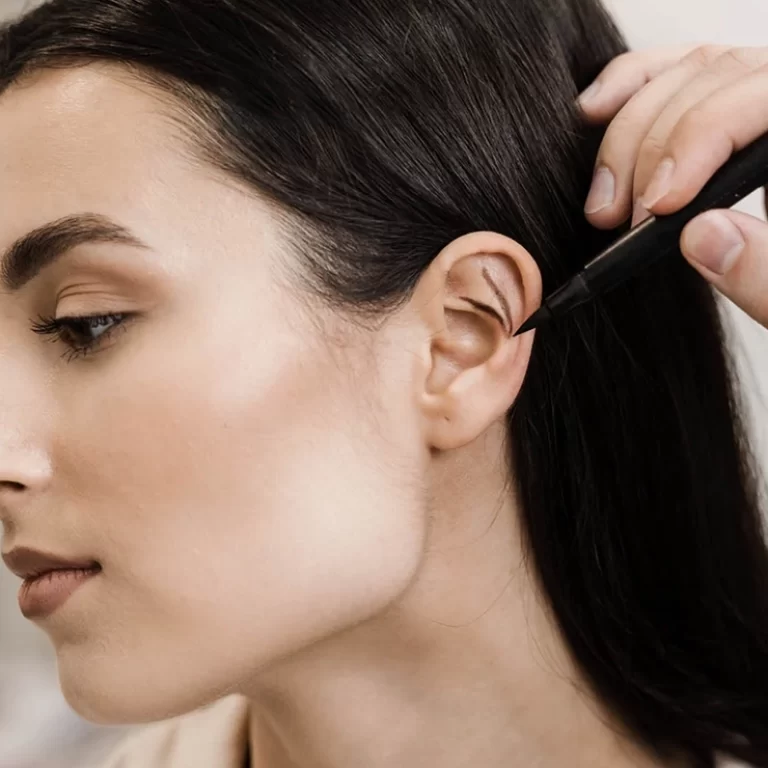 Otoplasty from our Tijuana, Mexico facial surgeon, Dr. Illich Navarro.